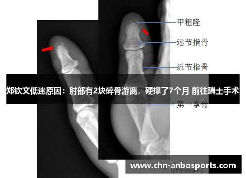 郑钦文低迷原因：肘部有2块碎骨游离，硬撑了7个月 前往瑞士手术